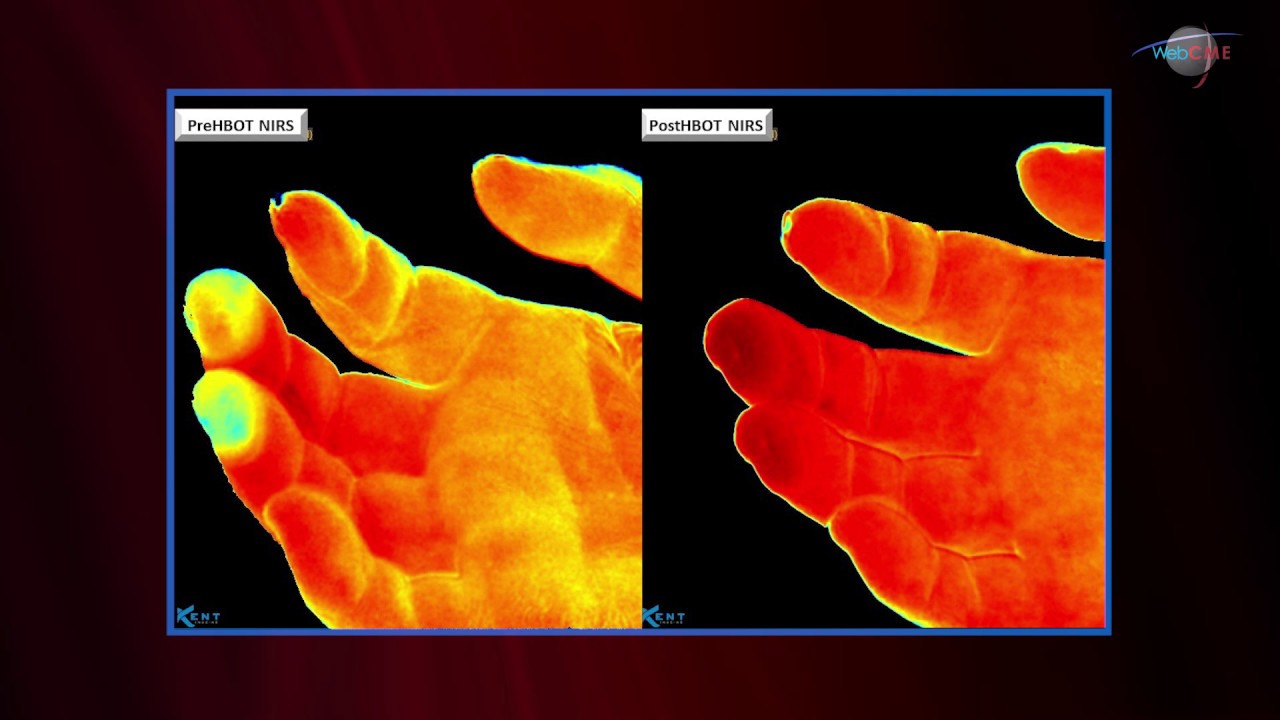 WCW: Treating Frostbite using Near Infrared Spectroscopy and Hyperbaric Therapy