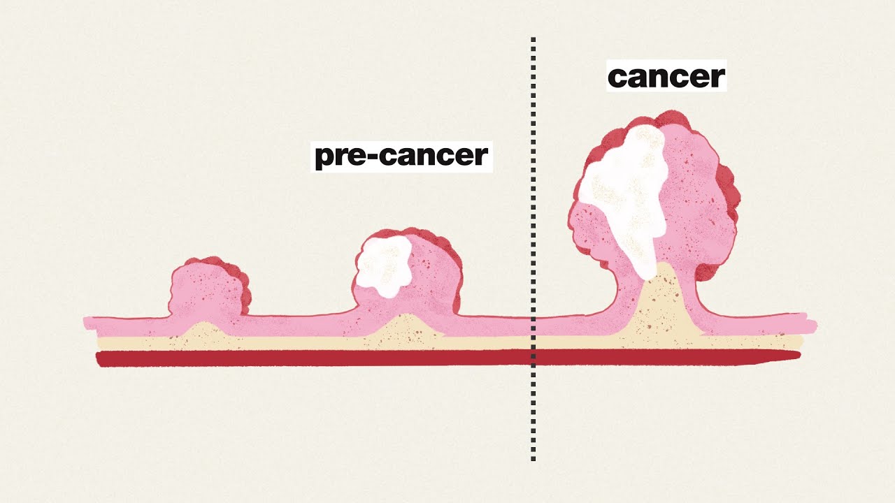 Colorectal cancer screening