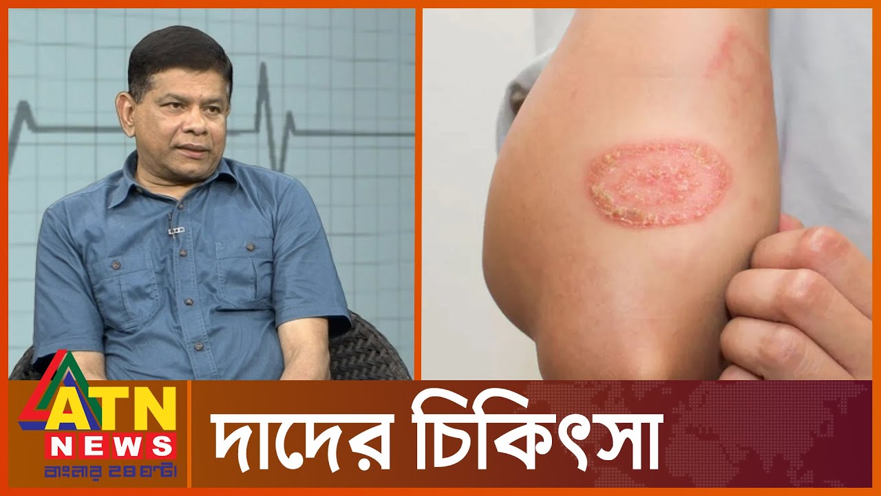 দাদ হলে  কী করবেন?  | Skin Desists | Ringworm |  Health Tips | ATN News