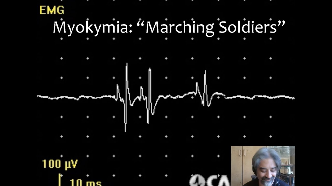 GMNR Legacy Series: EMG Waveform Recognition Workshop
