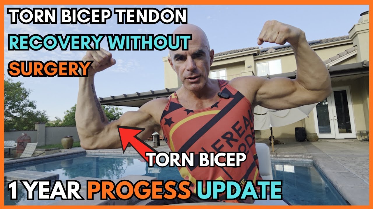 1 Year Later Torn Distal Bicep Tendon Rupture Recovery without Surgery | No Excuses