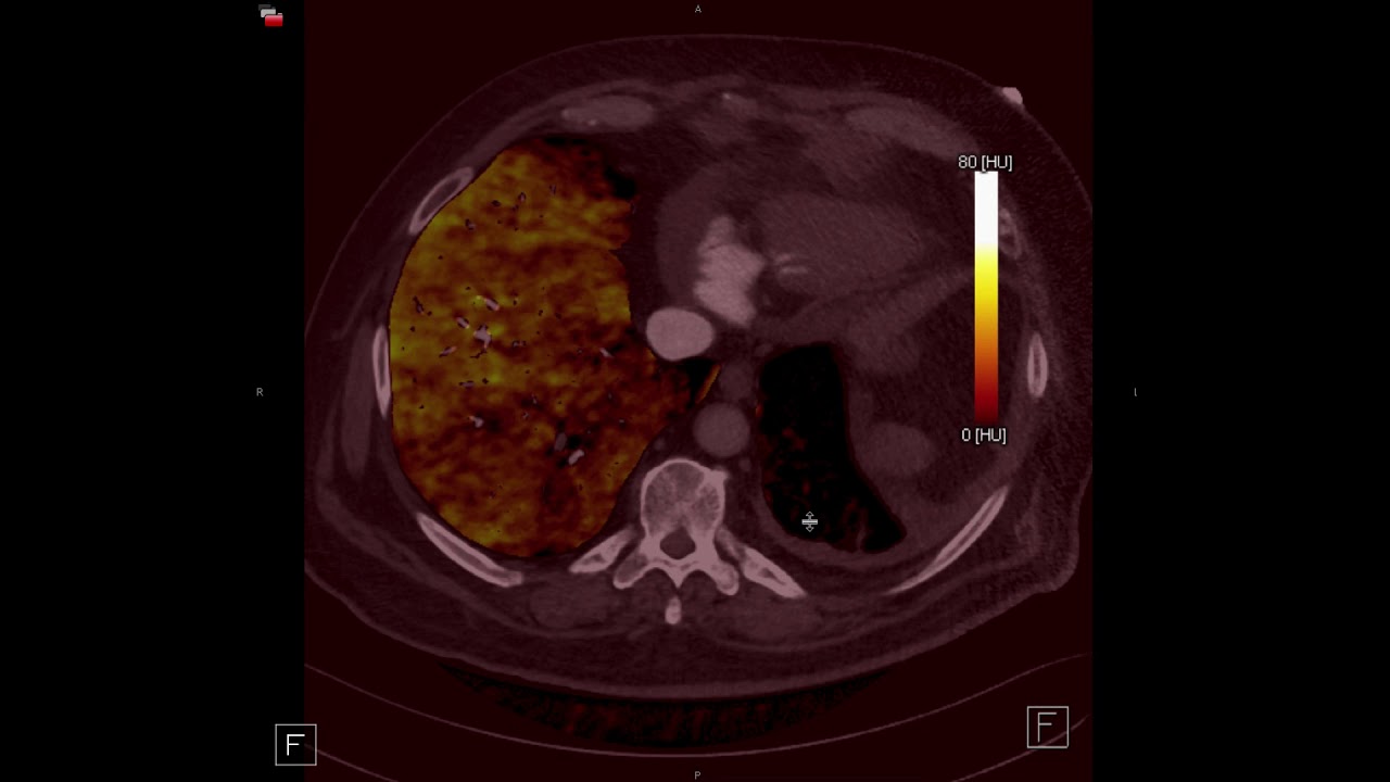 Chronic Pulmonary Embolism and CTEPH