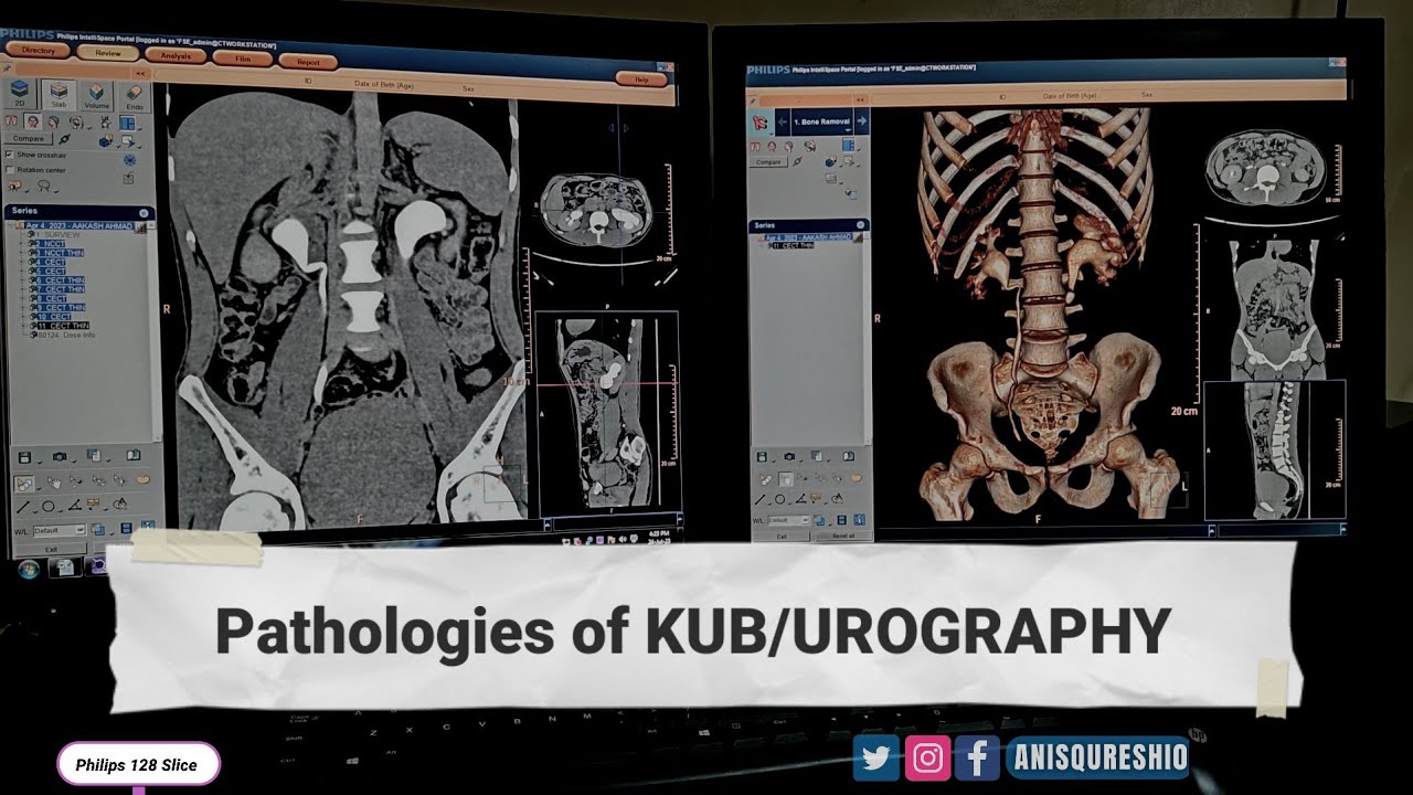 Pathologies of KUB/UROGRAPHY |CT SCAN| By Anis Qureshi