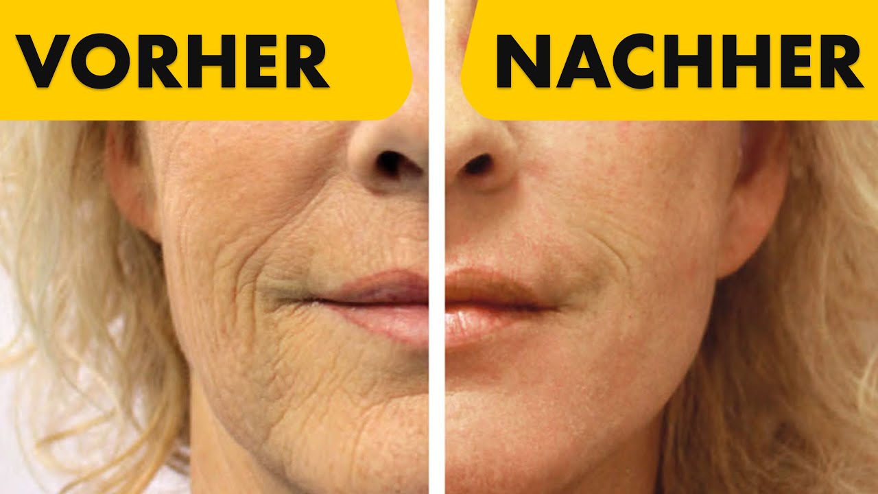 Wie lange hält ein Facelift? 7 Jahre danach! | Dr. Jungwirth - Plastische Chirurgie