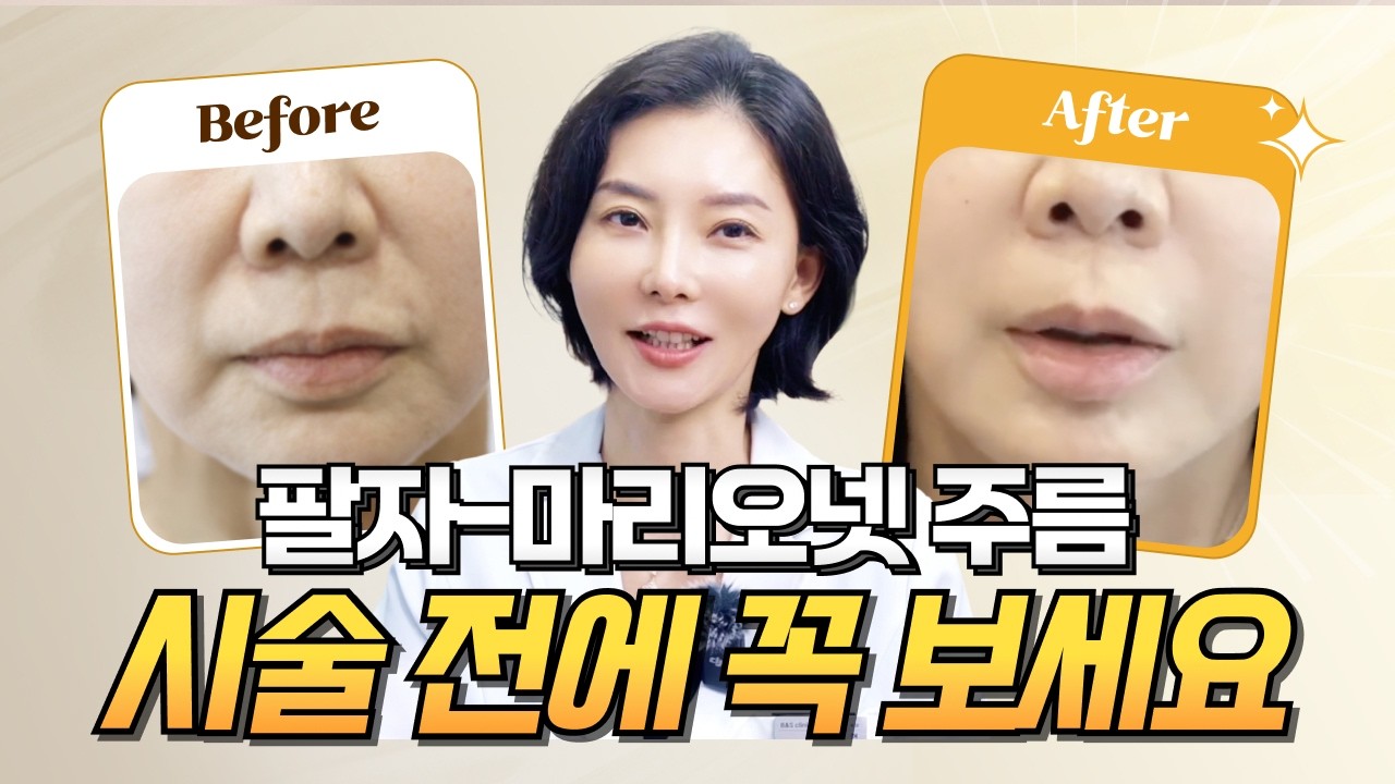 실리프팅, 이렇게 달라집니다‼️ㅣ팔자주름 시술 실제 후기 ㅣ붓기, 장단점, 유지기간ㅣ💡실리프팅 시술 전에 꼭 보세요!
