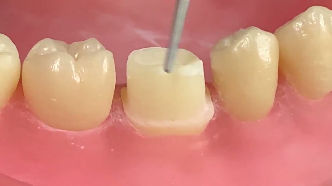 Preparo para coroa total em dentes posteriores