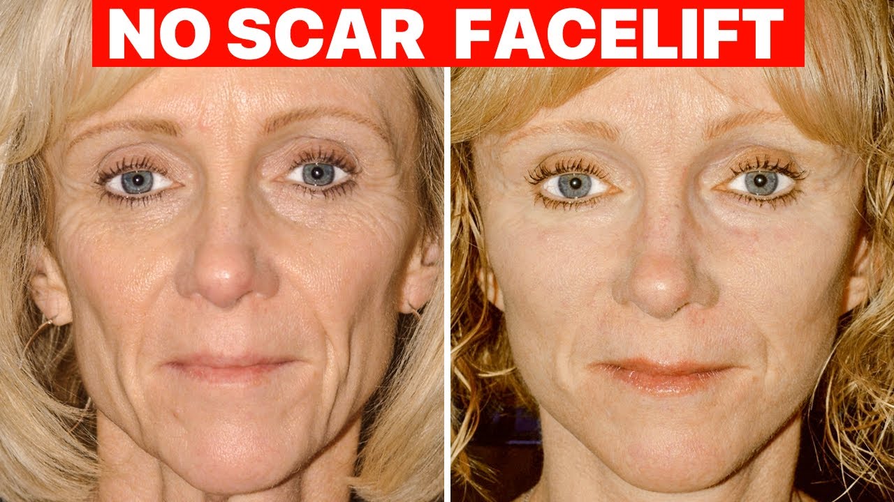 Scarless Facelift - Plastic Surgeon Explains