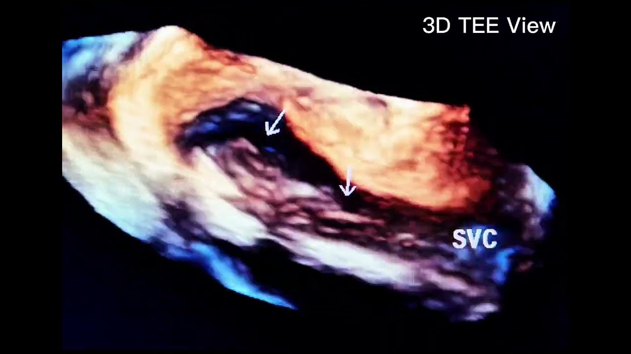 When the SVC Catheter Is Gone but Its Ghost Remains: Fibrin Sheath Explained