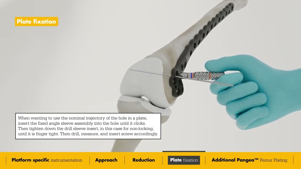 Pangea | Distal Femur Surgical Animation