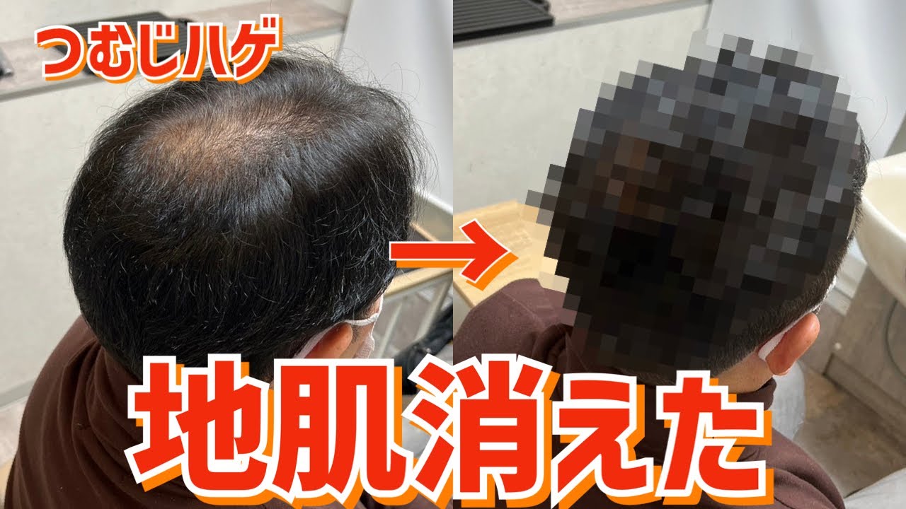 厚みが足りない薄毛をカットとセットでカバー！【頭頂部はげ】