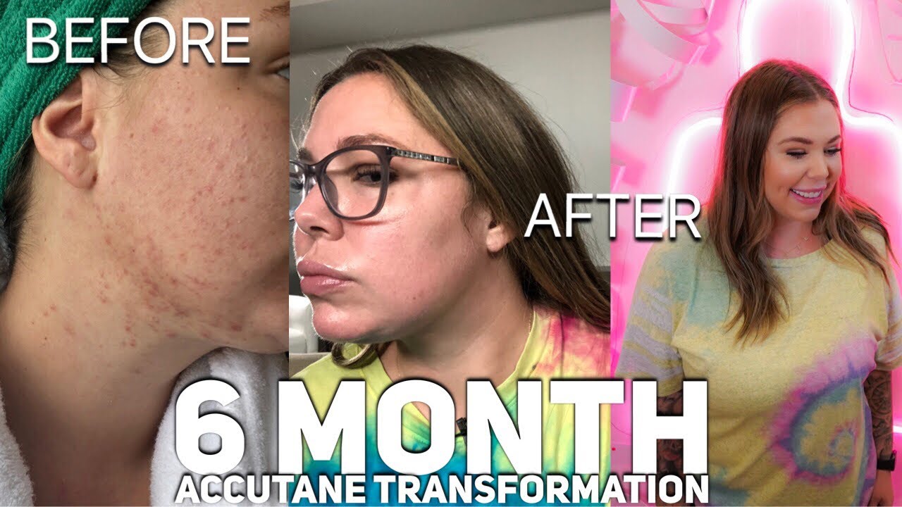 6 Month Accutane Transformation | My Accutane Journey