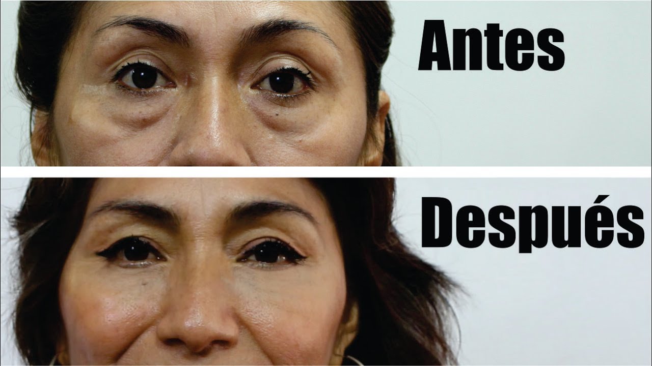 Bolsas en los Ojos 👁️ Párpados caídos 👀 BLEFAROPLASTÍA de ALICIA ❤️DR PERCY NEVADO  Cirugía Plástica