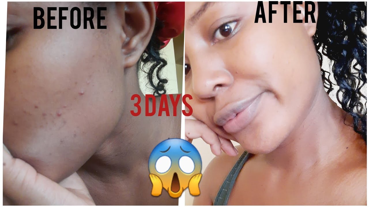 How to clear pimples/Acnes and Dark sports in days /Geisha black soap