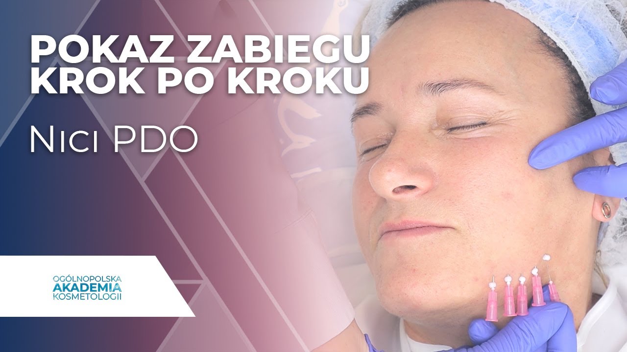 Nici PDO na twarzy | POKAZ ZABIEGU KROK PO KROKU |