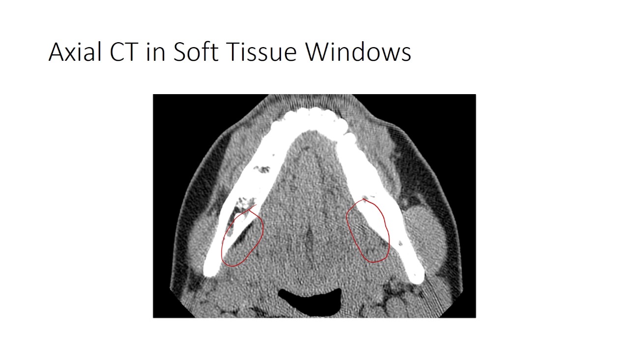 Sublingual Hematoma Sign