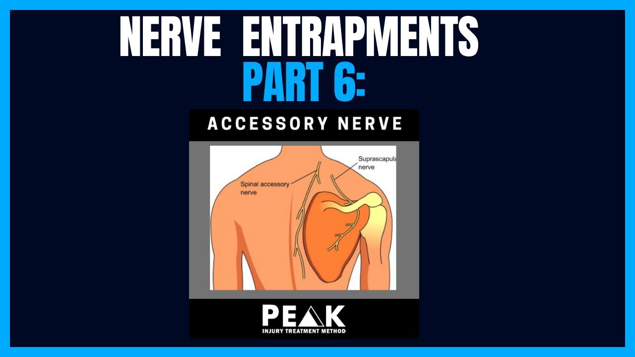 Nerve Entrapments Part 6: Accessory Nerve.