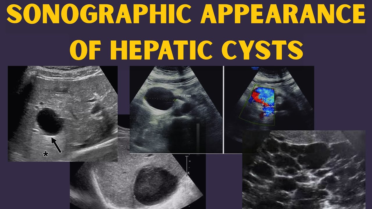Sonographic Features of Liver Cysts | Radiology Cases Tutorial