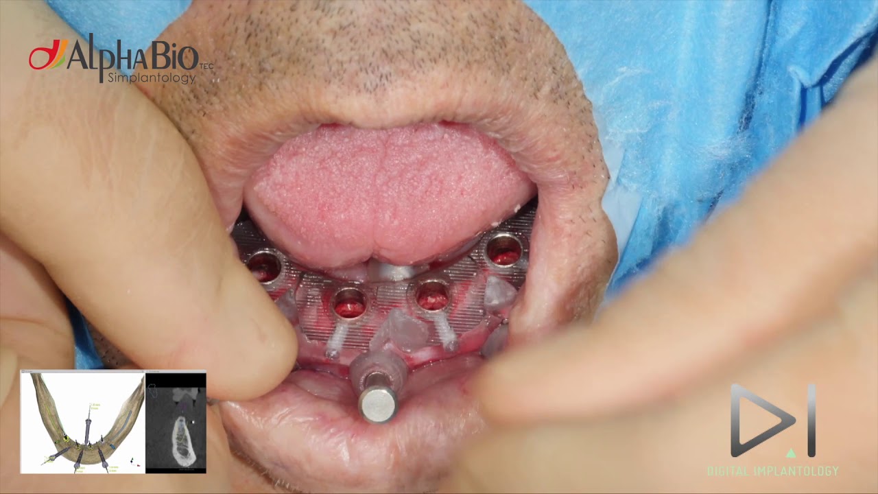 Guided Surgery. Immediate loading in lower jaw | Alpha-Bio Tec.