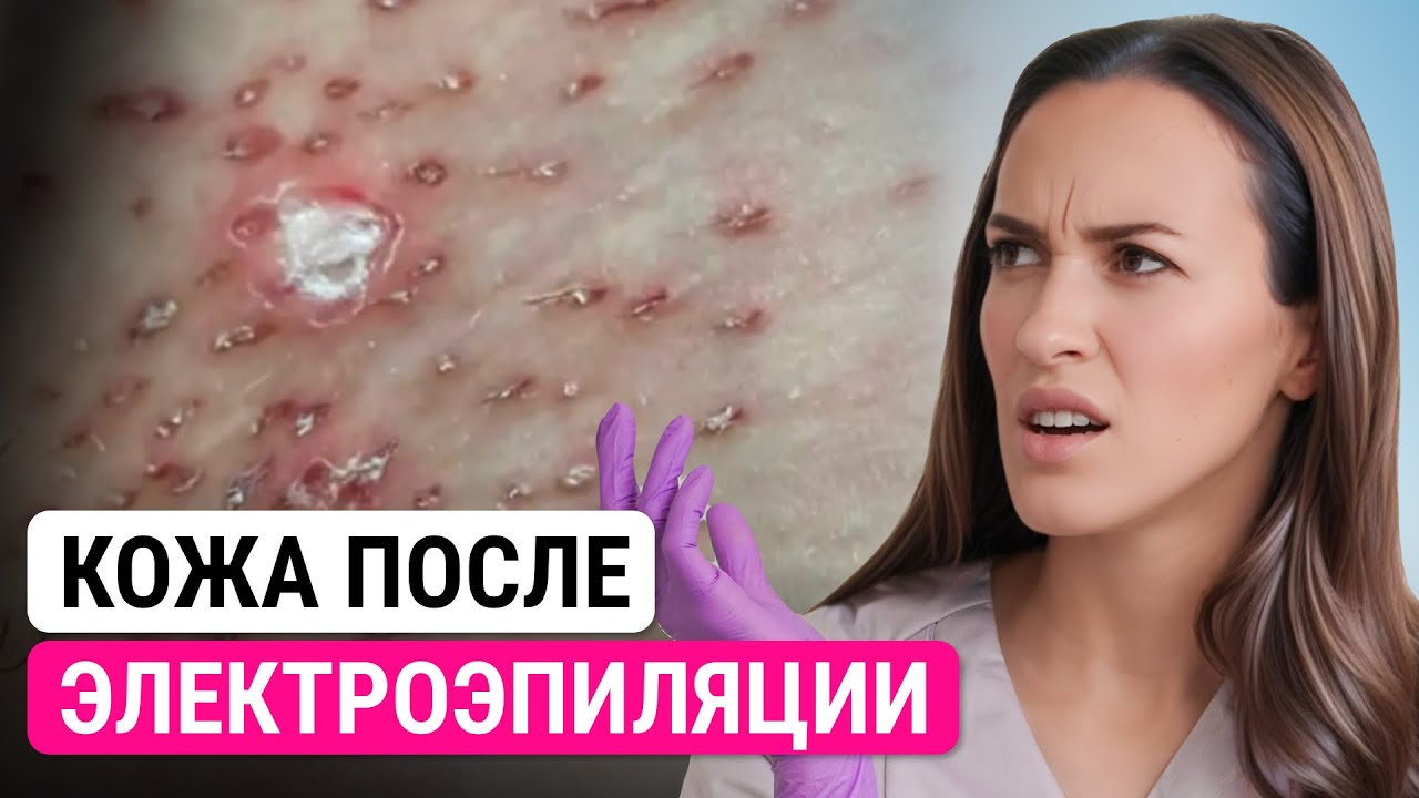 Урок №24. Почему есть корочки и норма ли это? Реакция кожи после электроэпиляции. Обучение