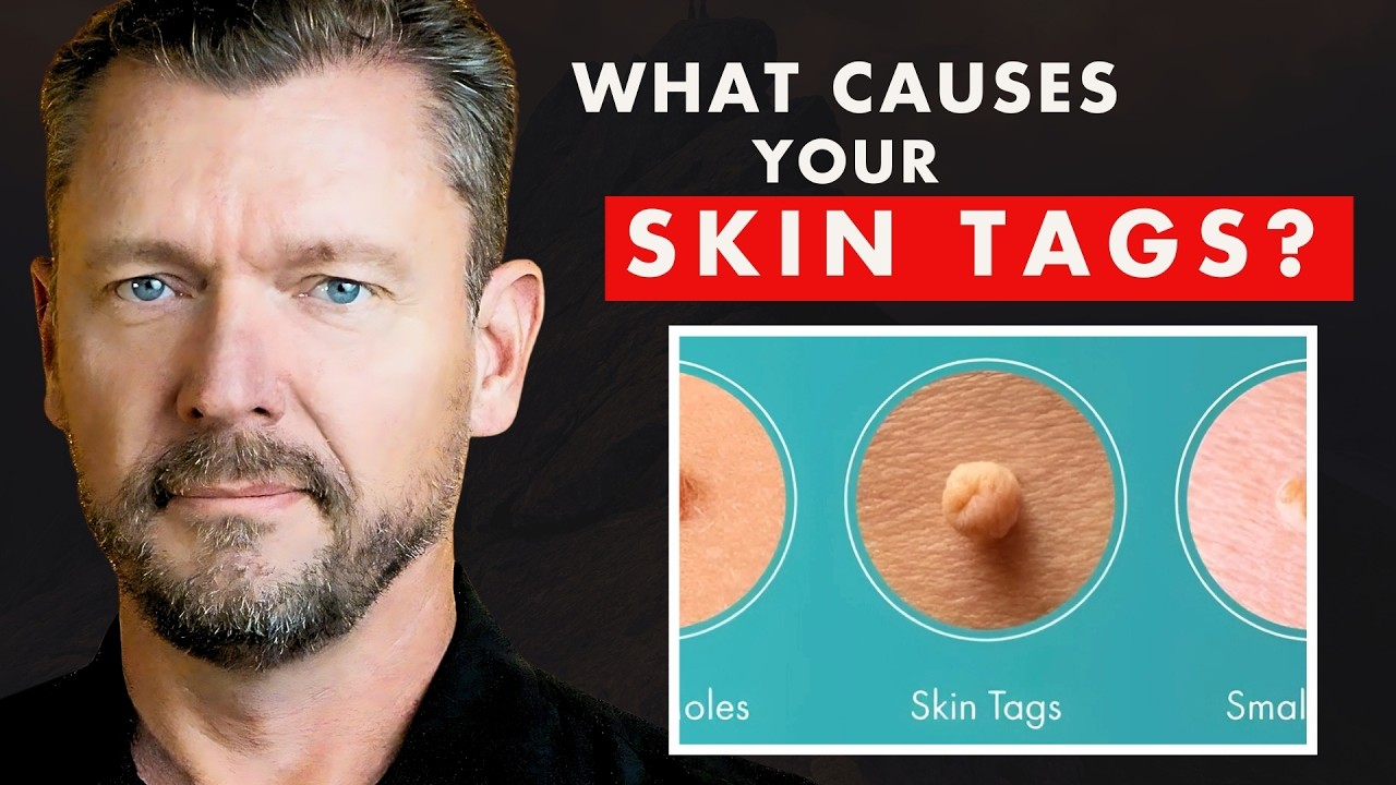 What SKIN TAGS Really Mean  (What Causes Skin Tags?)