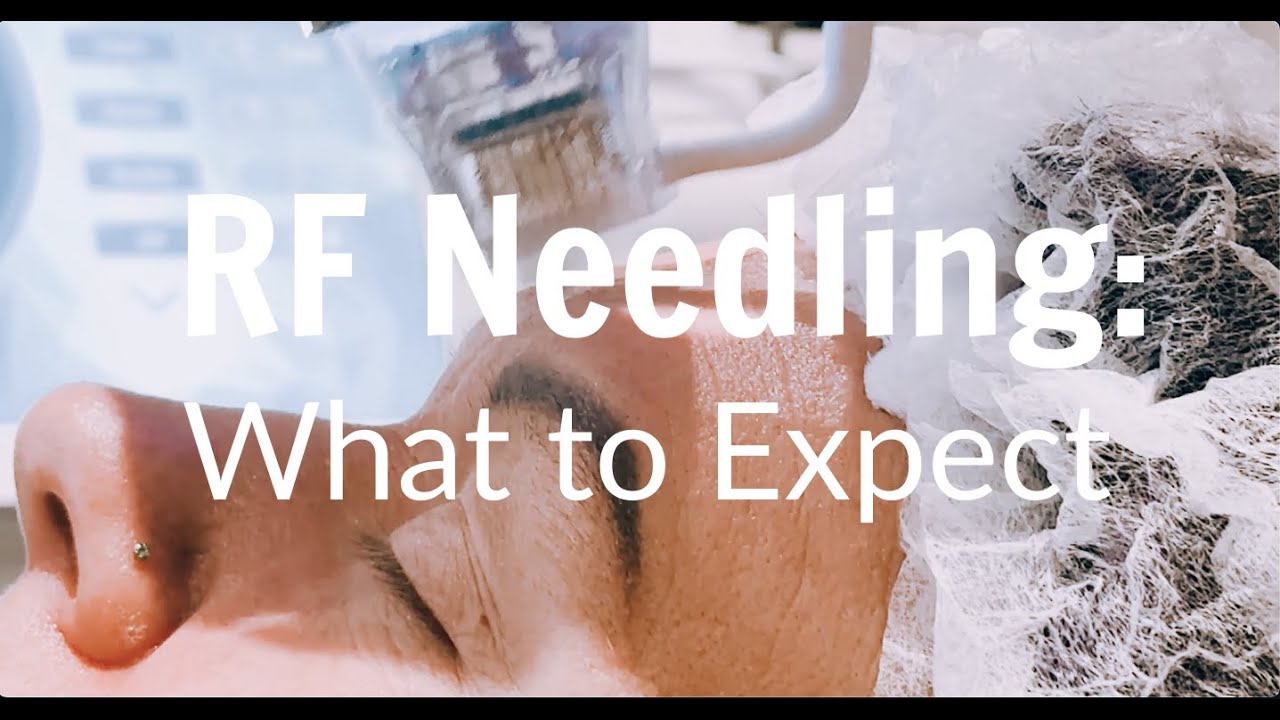 RF Needling at Rosem Health - What to Expect