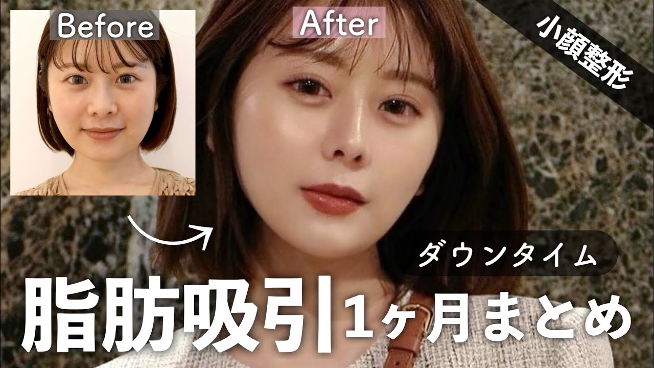 【小顔整形】脂肪吸引と糸リフト1ヶ月経過まとめ👩🏻リアルなレポ動画をお届け！✨