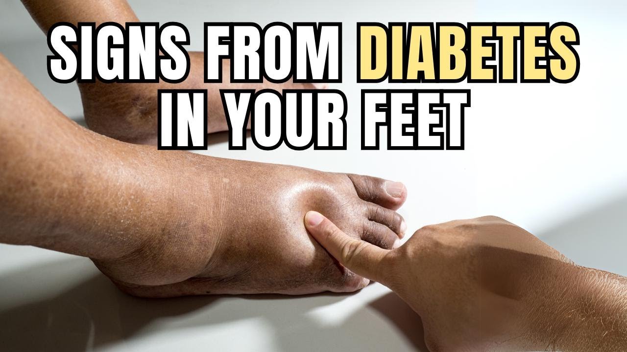 Don't ignore! A doctor explains the early symptoms of diabetes foot, a regrettable complication.
