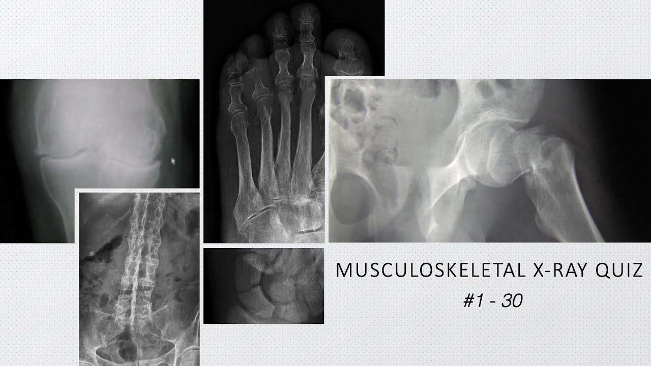 Musculoskeletal X-ray Quiz #1 - 30