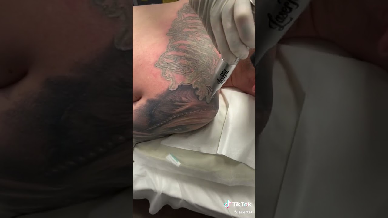 LaserTat Tattoo Removal. Timelapse of a large laser treatment.