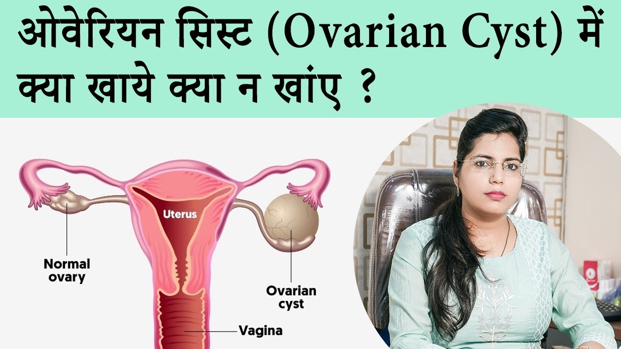 ओवरी सिस्ट में क्या खाना चाहिए क्या नहीं? | What to Eat to Cure Ovarian Cyst - Dr. Chanchal Sharma
