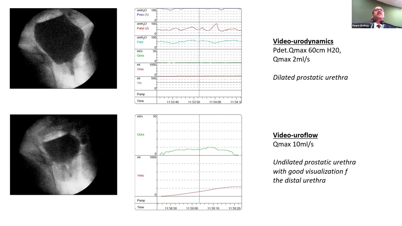 Urodynamics   Interpretation and Reporting by Dr Sanjay Sinha