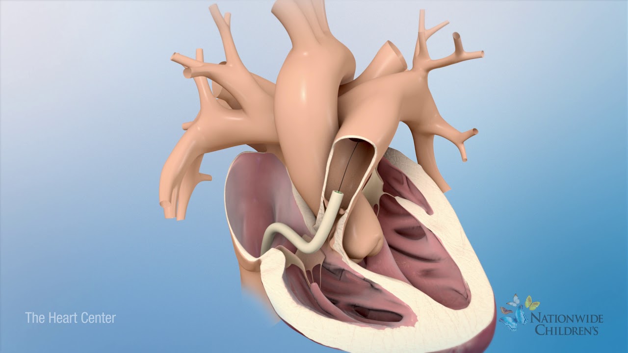 Tetralogy of Fallot (TOF): Animation Explains Heart Defect and Repair