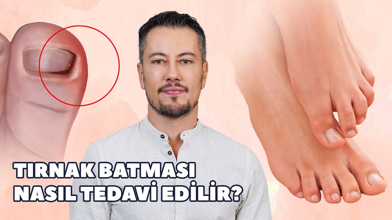 Tırnak Batması Nasıl Tedavi Edilir?