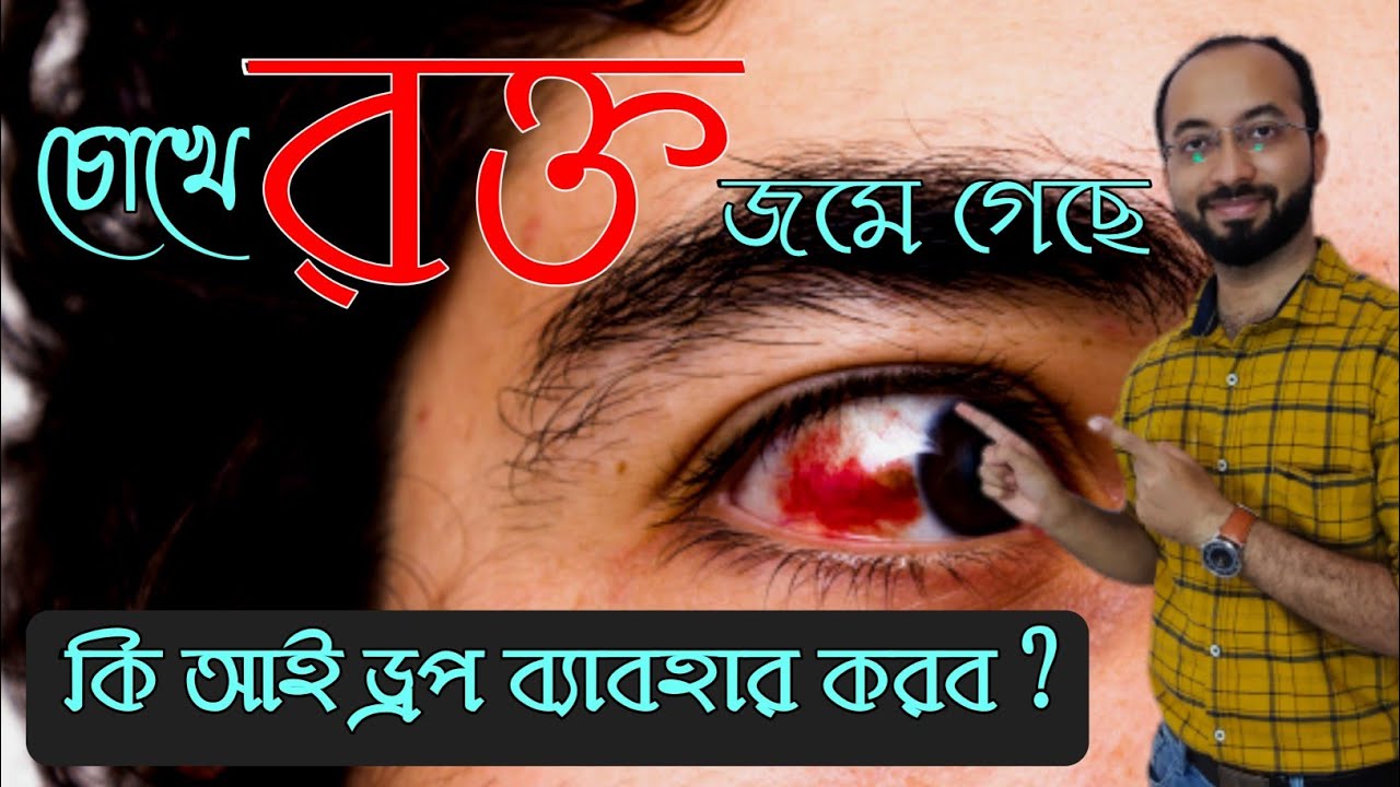চোখে রক্ত জমলে কি আই ড্রপ ব্যবহার করবো |  Eye Drop For Blood Clot In Eyes |  চোখে রক্ত জমলে করণীয়