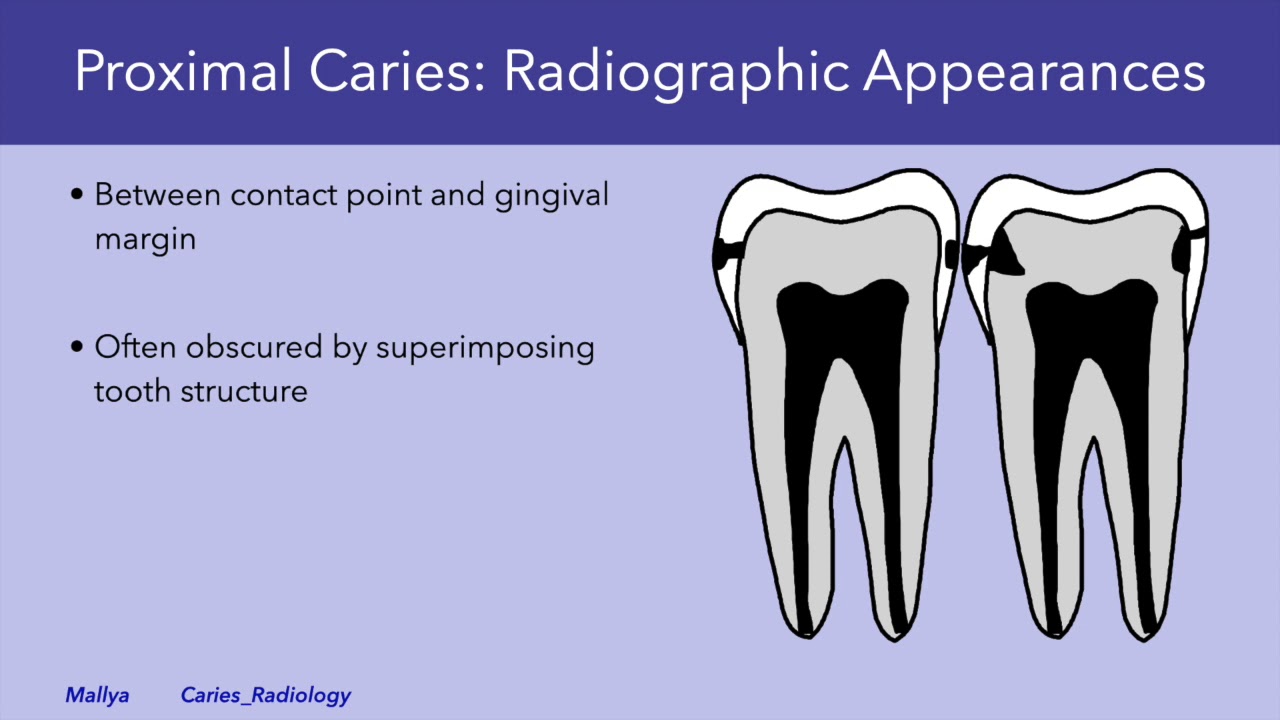 Radiologic Detection and Evaluation of Caries