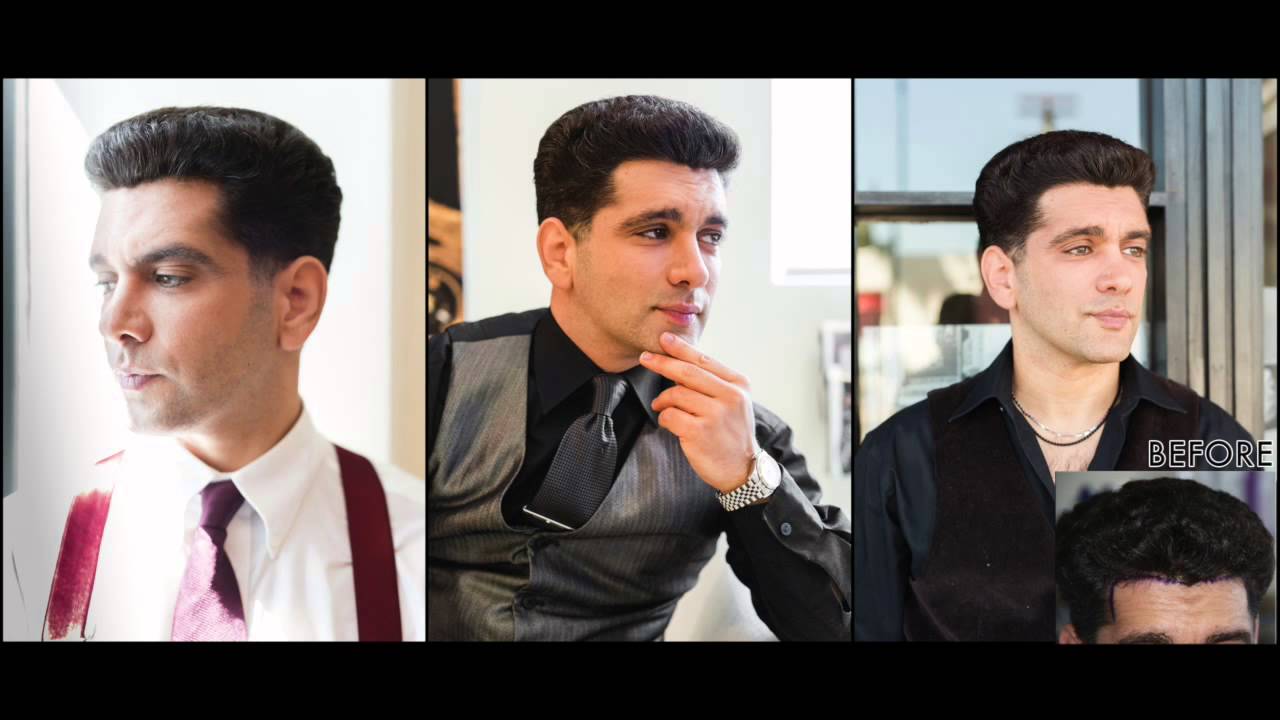 FUE Hair Transplant Results &ndash; Dr. Baubac Hayatdavoudi | Alvi Armani