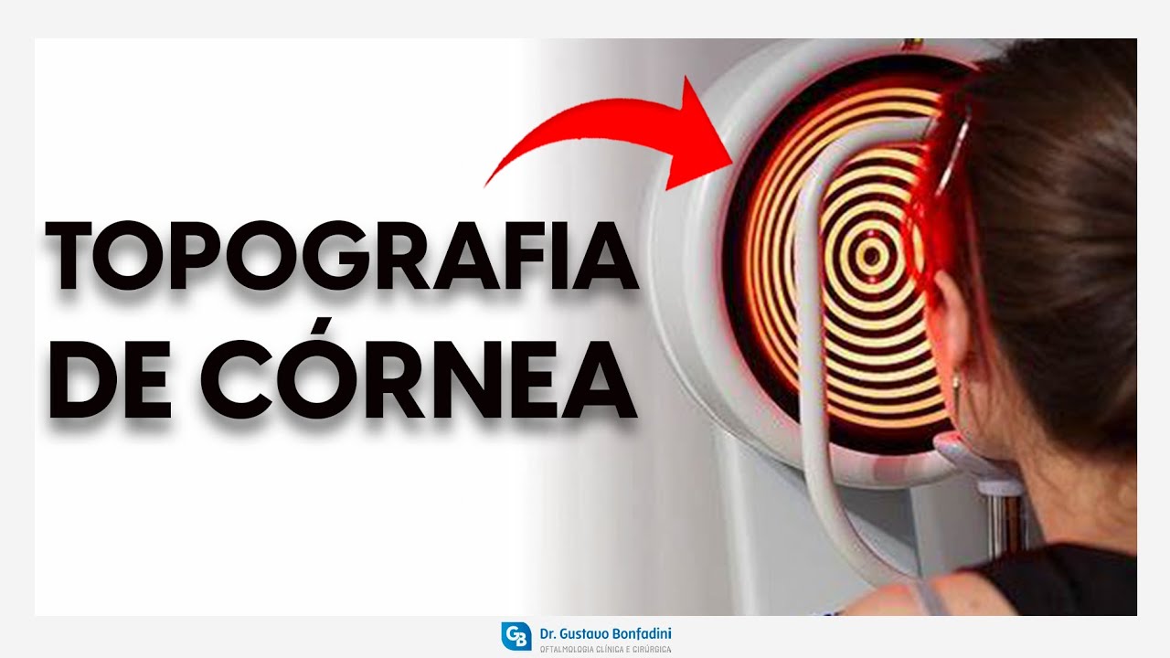 Topografia de córnea - Dr.Gustavo Bonfadini