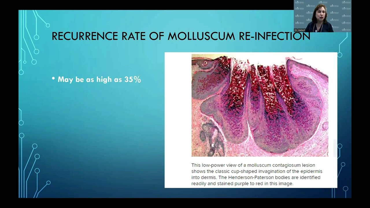 Molluscum Miniseries: Advances in Understanding and Managing Molluscum in Children - Episode Two