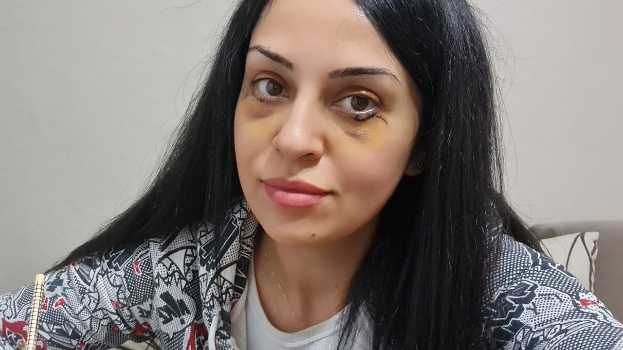 G&ouml;z Altı Torba Ameliyatı Sonrası İlk 1 Hafta 😵&zwj;💫 &Ouml;ncesi & Sonrası T&uuml;m Detaylar #Blefaroplasti