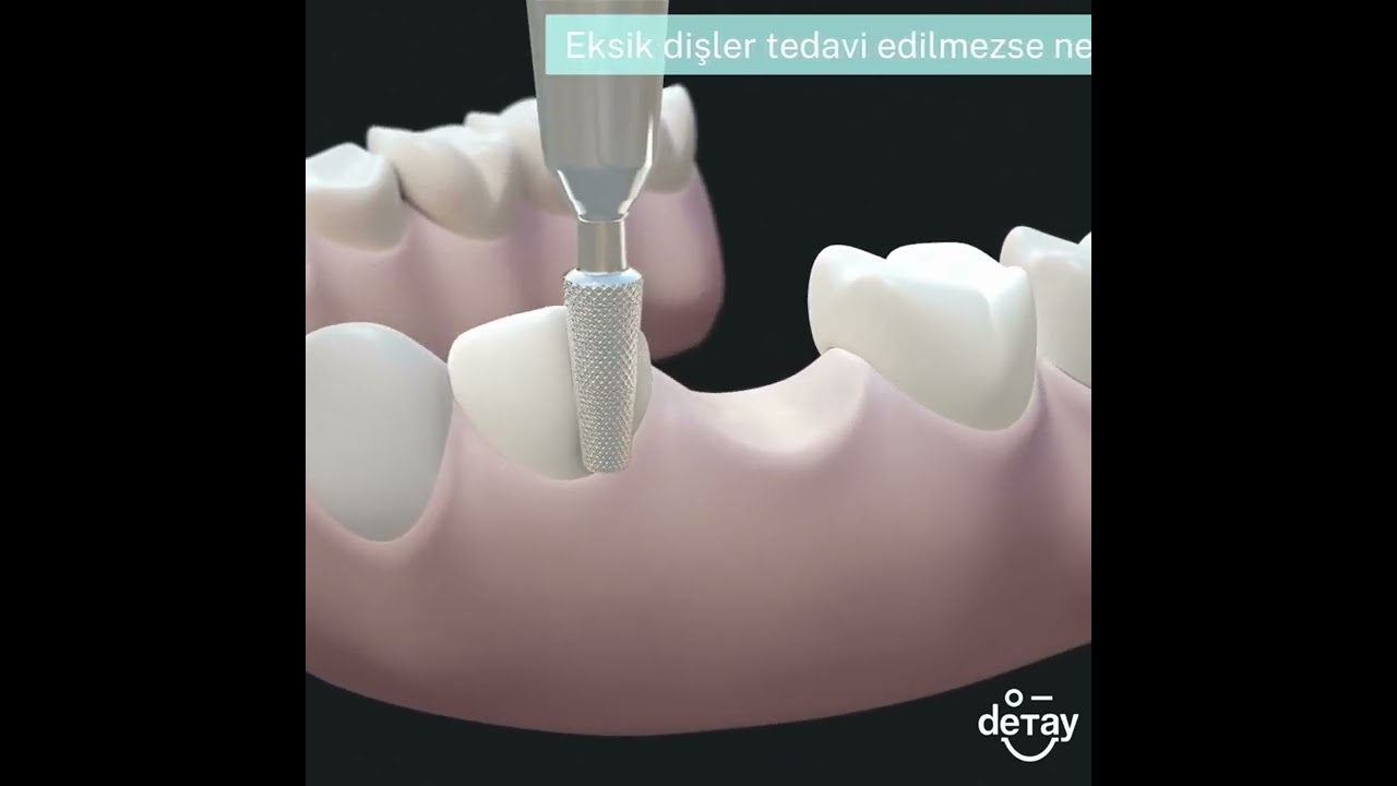 Eksik diş tedavisi