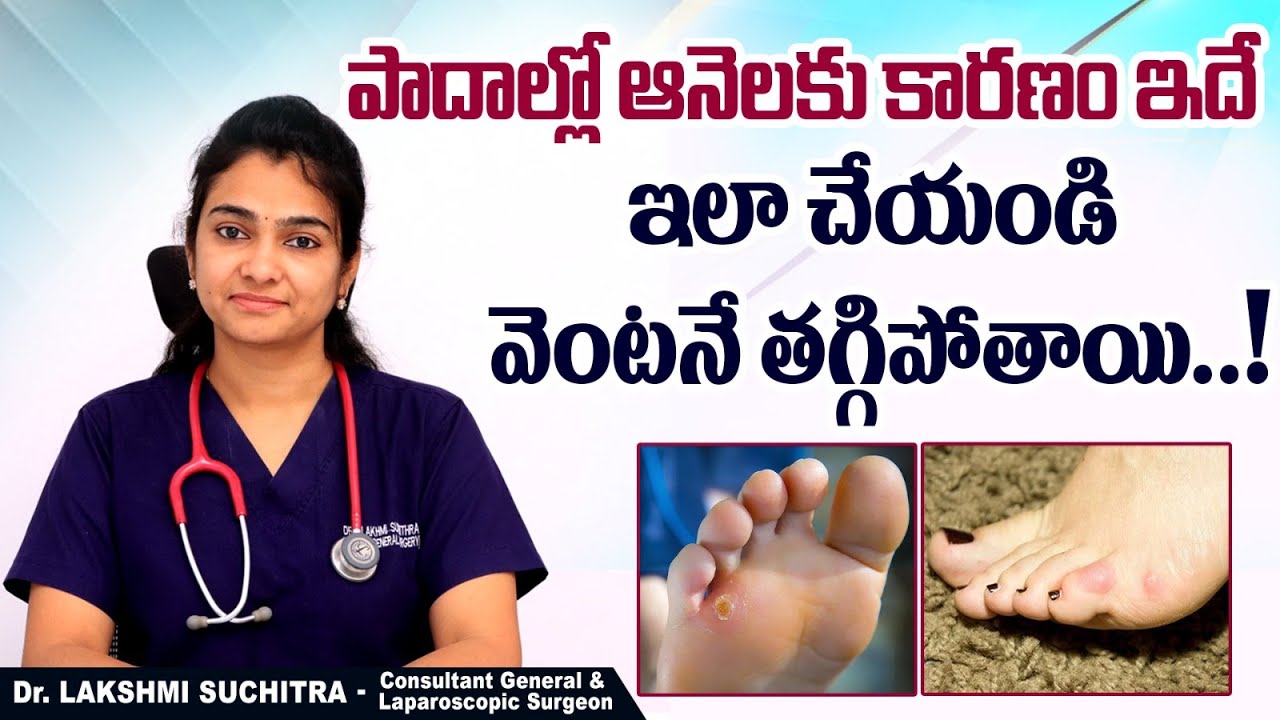 పాదాల్లో ఆనెలకు సరైన పరిష్కారం || What Causes Foot Corns? || Best Treatment for Foot Corns in Telugu