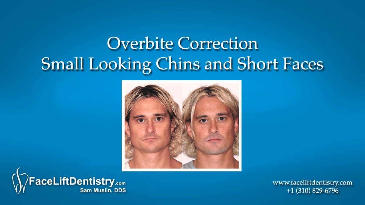 Overbite Correction – Small Looking Chins and Short Faces