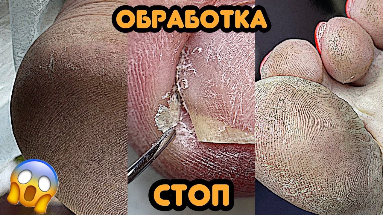 Педикюр обработка стоп 💅 Удаляем подногтевую мозоль / Летний матовый педикюр