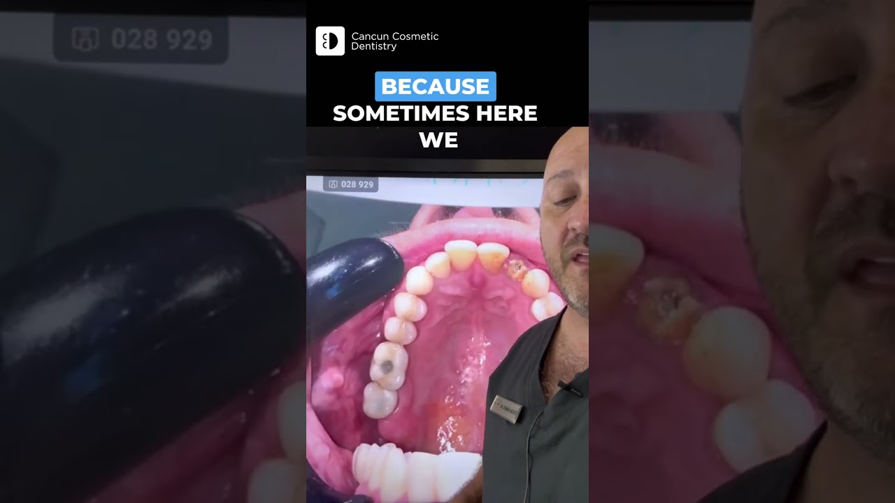 🤔 Broken tooth extraction and then implant? Is it possible??  🤔