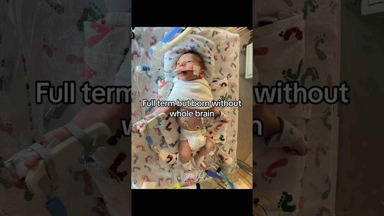 My baby was born full term but doesn&rsquo;t have all of his brain BUT JESUS #jesus #specialneedsparenting