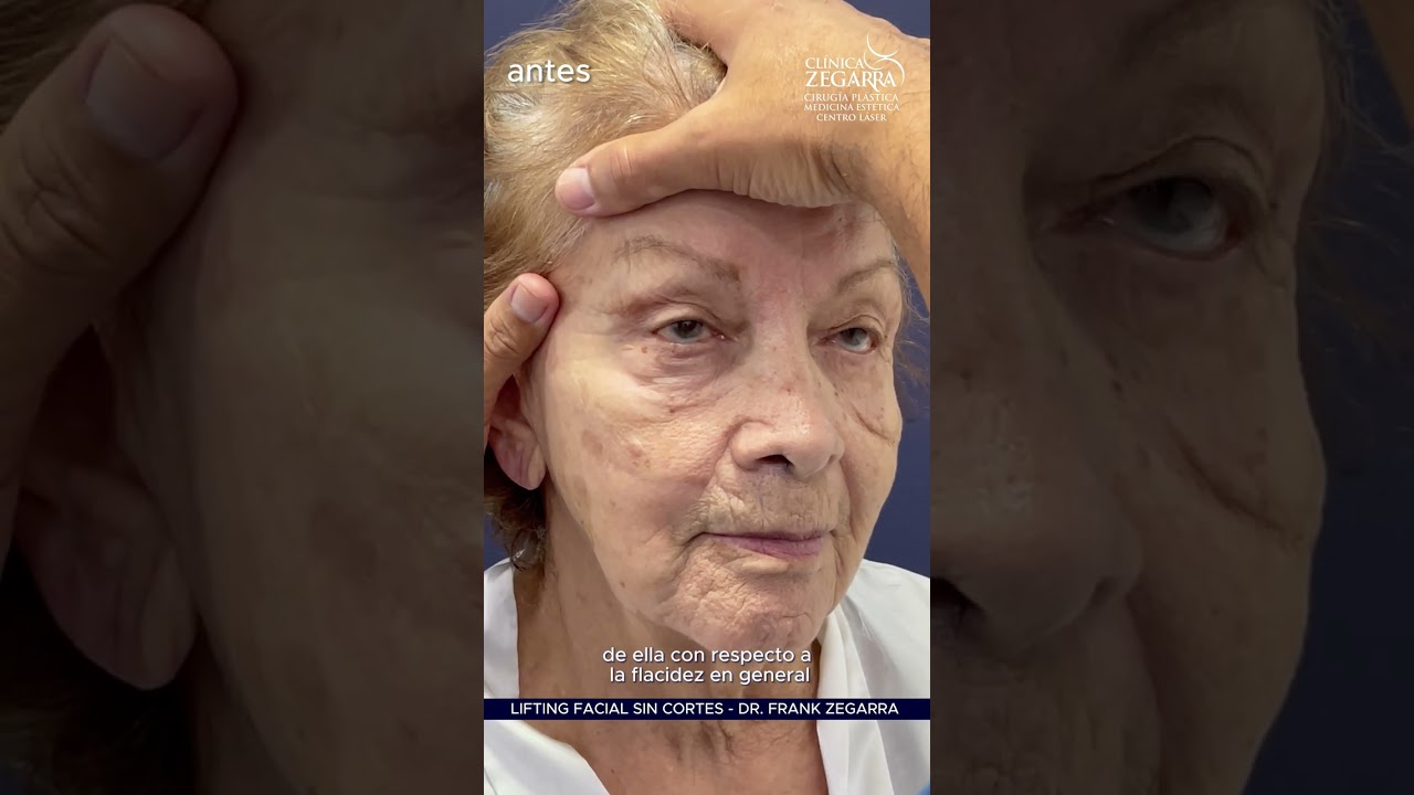 LIFTING FACIAL SIN CORTES - NUEVA TÈCNICA - DR. FRANK ZEGARRA