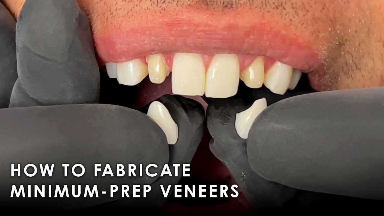 How to Fabricate Minimum-Prep Veneers