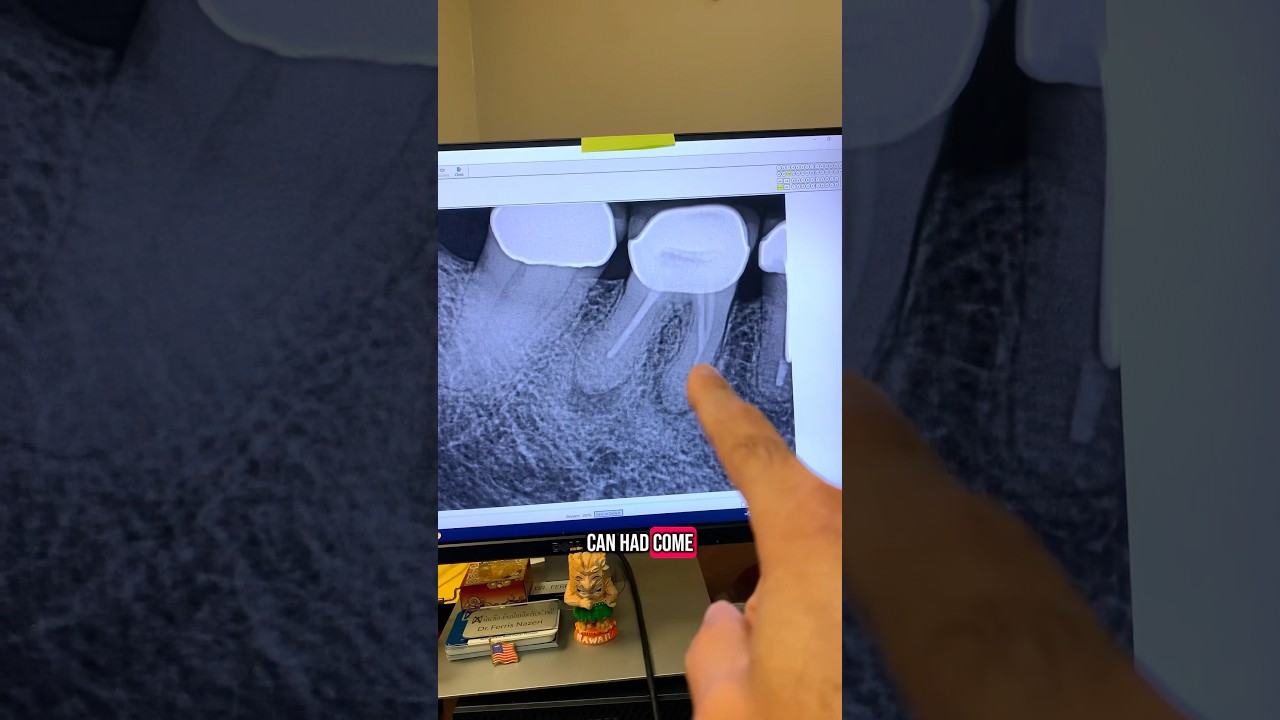 You can&rsquo;t do root canals like this & expect success! Endo retx of tooth #30. #endodontics #dentists