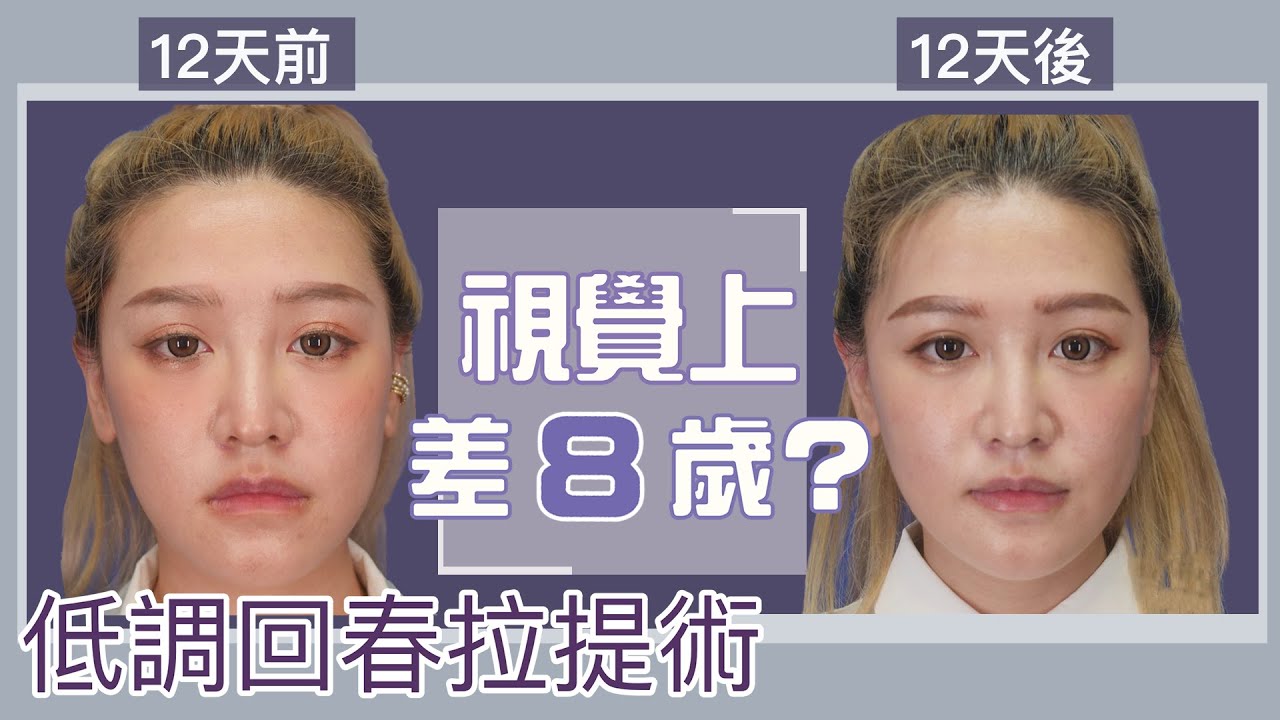 網友驚呼視覺上年輕8歲！MINT神力拉提效果好嗎？術前術後完整心得紀錄！