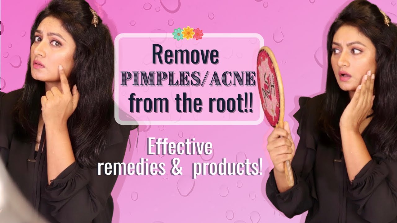 How I got rid of pimples/ance from the root||Effective & Easy Remedies||Lifestyle changes||Ashtrixx